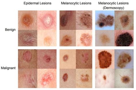 Melanoma Skin Cancer Signs