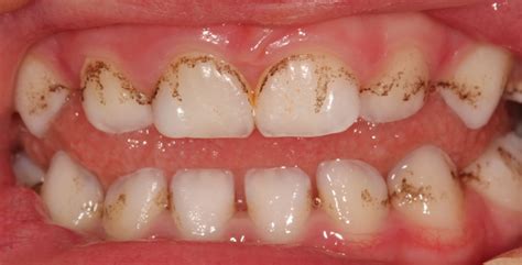 Black Stains on the Teeth: Major Causes and Best Solutions | New Health Advisor