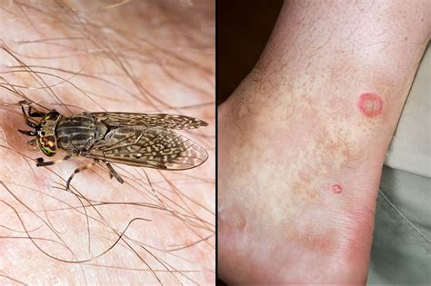 Insect bites and stings - Symptoms - NHS