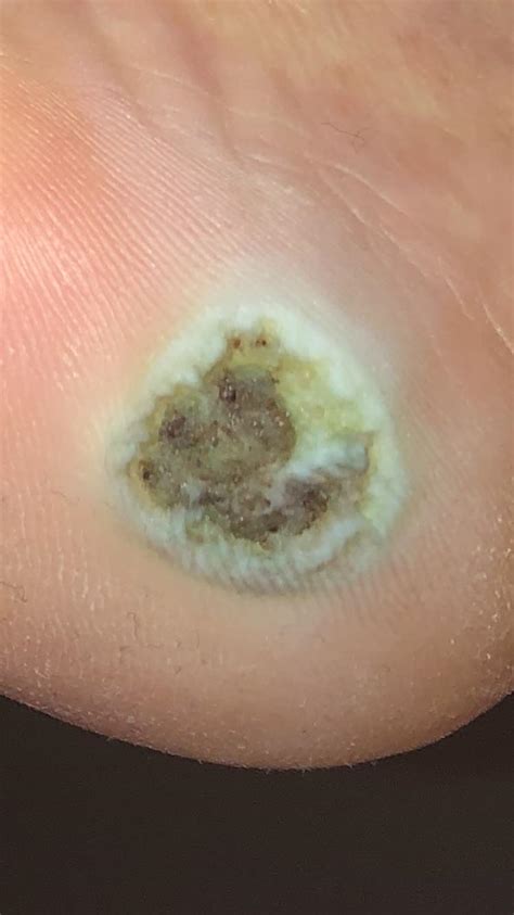 UPDATE - Day 16 of duct tape on a plantar wart : r/Warts