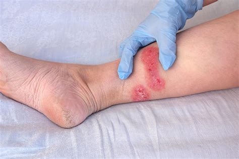 How To Heal Recurring Diabetic Sores On Legs With Amniotic Allografts