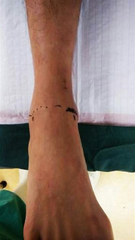 Pigmented Villonodular Synovitis (PVNS) of the Ankle Treatment