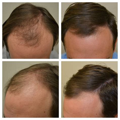 Minoxidil Before and After Photos [2022] | Is it right for you?