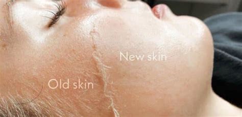 The Benefits of Dermaplaning | Glamor Medical