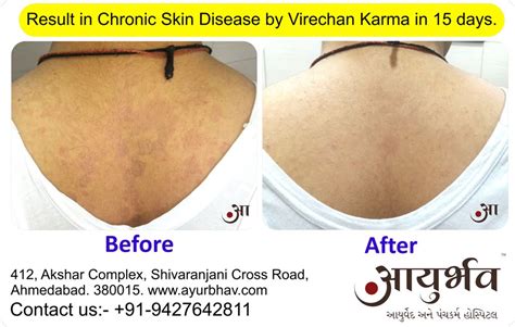 Best Panchakarma Result in Chronic Skin Disease – Ayurbhav | Ayurved ...