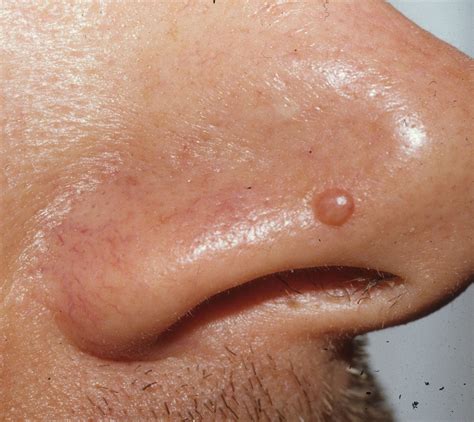 remove fibrous papule of the nose at home - bestpricedrawingsofflowerspencil