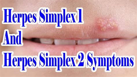 Herpes Simplex 1 And 2 Symptoms : Which Herpes You Are Suffering From HSV 1 Or HSV 2 - YouTube