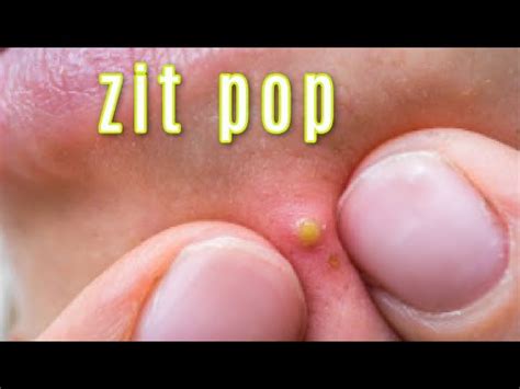 Blackheads 2021 Newest•Blackhead Removal•Nose Blackhead•Pimple Popping ...