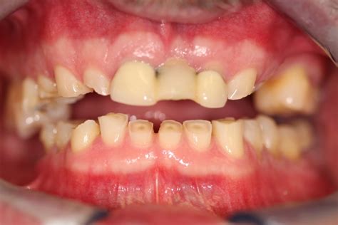 Crown Lengthening (Restorative) | Tyler Periodontics