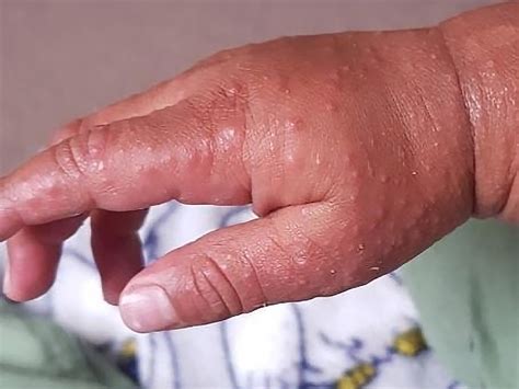 Hand, foot, and mouth disease | BabyCenter