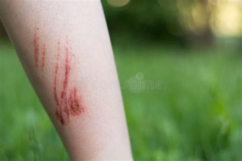 Abrasions to the forearm stock image. Image of healing - 74491815