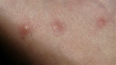 can dust mites bite People : you need to know about it