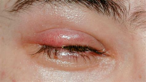 Eyelid Pimple Inside