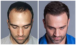 What Is The Bosley Guarantee? - Bosley Hair Transplant