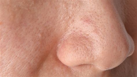 Sebaceous Filaments: About, Vs. Blackheads, Why to Leave Alone