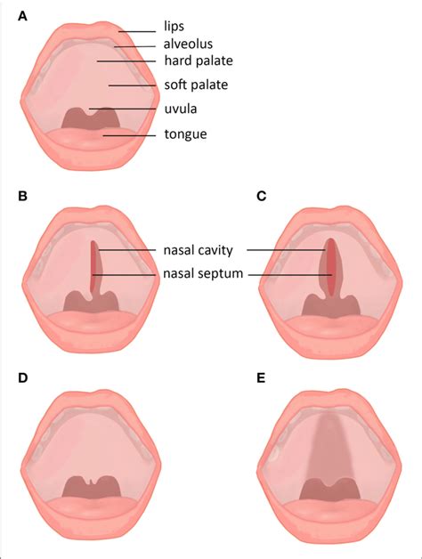 Cleft Palate Anatomy - Anatomical Charts & Posters