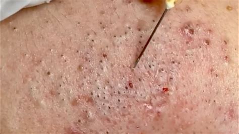 Dr Pimple Popper Blackhead Extraction Pops at William Frazier blog