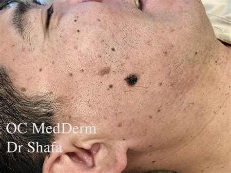 Skin Biopsy Procedure at OC MedDerm | Irvine & Orange County Dermatology