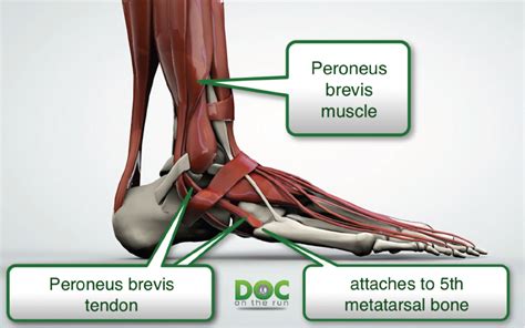 Doc On The Run Podcast: Peroneus Brevis Tendinitis in Runners