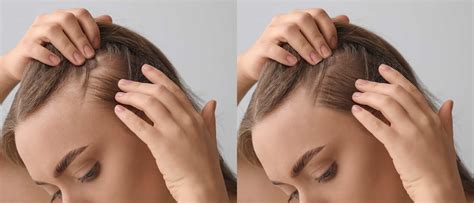 Hair Loss In Women: Causes, Treatment & Prevention