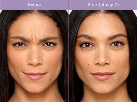 Botox Injections Recovery | Marietta, Atlanta, Roswell, Sandy Springs Georgia