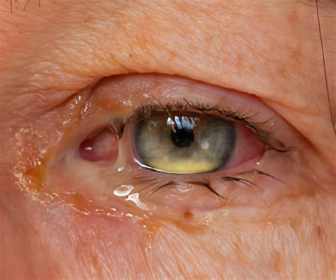 Fusarium Eye Infections Keratitis And Endophthalmitis - vrogue.co