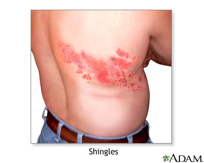 Shingles (Herpes Zoster) - Symptoms and Causes | Penn Medicine