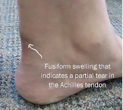 Achilles Tendon Ruptures | Causes and treatment options | MyFootShop.com