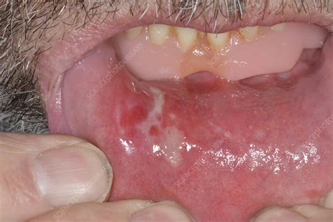 Mouth ulcer inside lower lip - Stock Image - C047/3039 - Science Photo ...