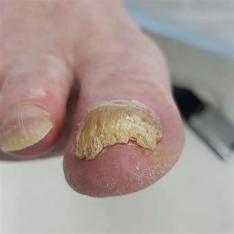 Thick Toenails: Cause, Symptoms & Treatment