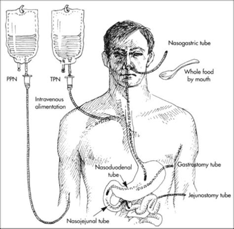 Total Parenteral Nutrition (TPN) | Nursing information, Nursing study ...