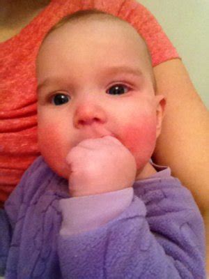 Teething rash or eczema???... anyone else!?! | BabyCenter