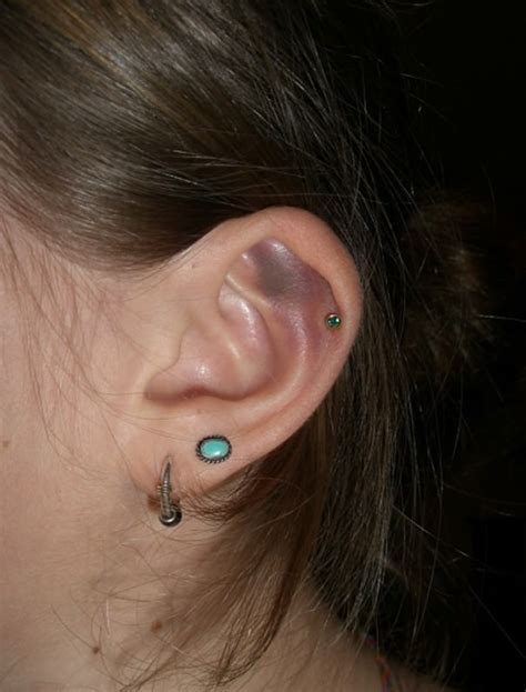 Infected Cartilage Piercings – Causes, Symptoms & Treatment