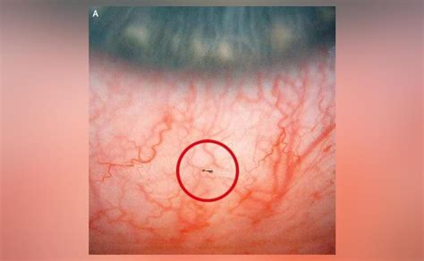 Over 12 maggots removed from man's eye in France; pic surfaces | Science News | Inshorts