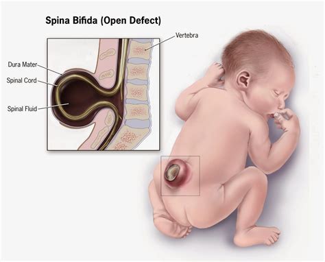 Sensory care Paediatric Services: So your baby has Spina Bifida Bacterial Meningitis, Dura Mater ...