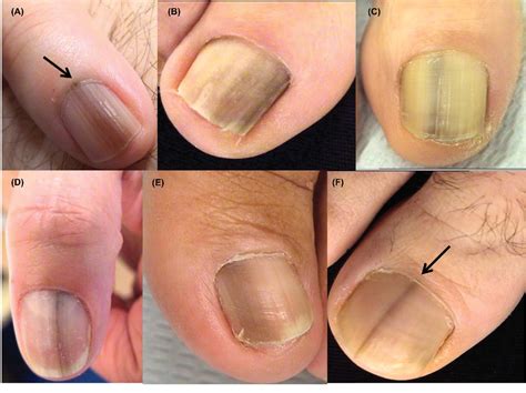 Ostia! 30+ Fatti su Melanoma Nail Symptoms! This is more common in people with dark skin but can ...