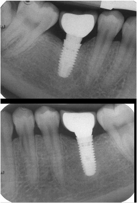 IOPA x ray after cementation of final prosthesis. | Download Scientific Diagram