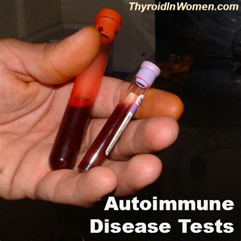 Three NEW Tests For Autoimmune disease | Autoimmune disease, Disease, Autoimmune