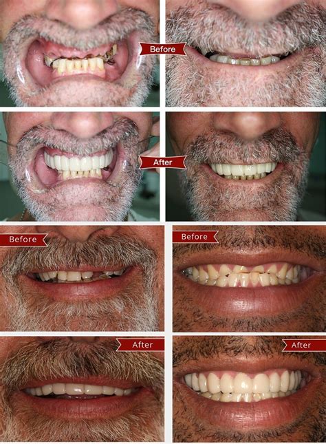 🔥HOT SALE🔥🎉 - Latest👨‍⚕Adjustable Snap On Dentures😁 (💥50% OFF)