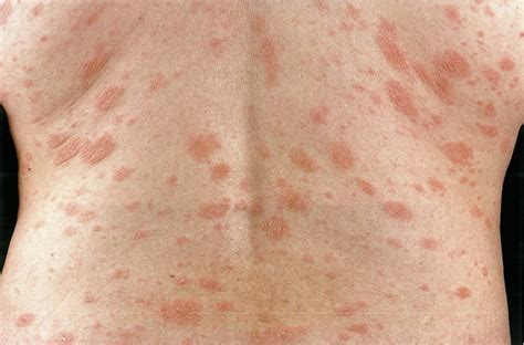 Pityriasis Rosea Treatment