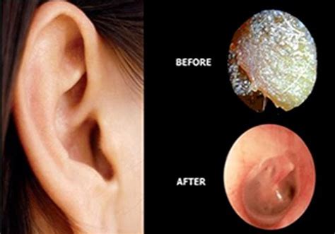 Microsuction - Rochdale Ear Care Clinic