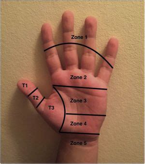 Flexor Tendon Zones Hand