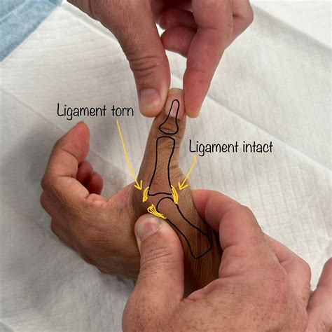 Thumb Ulnar Collateral Ligament (UCL) Repair | Dr Oscar Brumby-Rendell | Orthopaedics