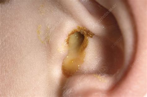 Infected Ear From Earing | tiandemk.mk