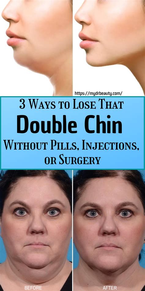 Awasome How To Get Rid Of Double Chin Surgery 2022