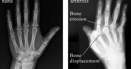 Rheumatoid Arthritis - Facts, Risk And Treatments ~ Way To Be Healthy