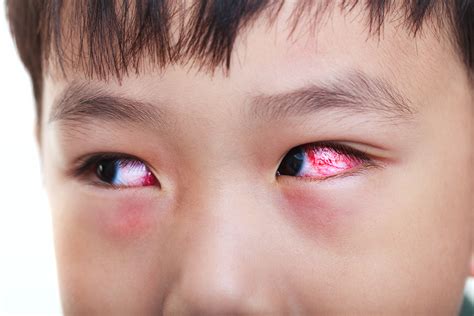 How to Tell If Your Child Has an Eye Infection - IBI Atlanta