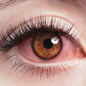Pink Eye Home Remedies, Natural Remedies, Pinkeye Remedies, Eye Pain, Eye Relief, Types Of Eyes ...