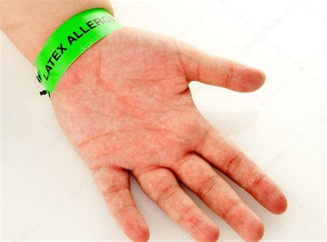 Latex Allergy Rash Stock Photo by ©Enigmangels 37839853