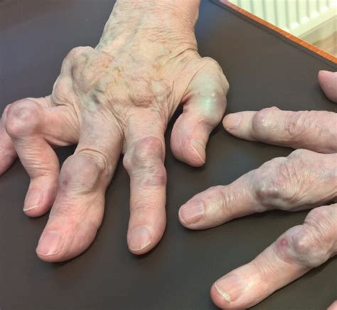Unusual hand nodules | The BMJ